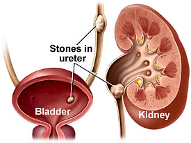 Possible Complications Bladder Stones